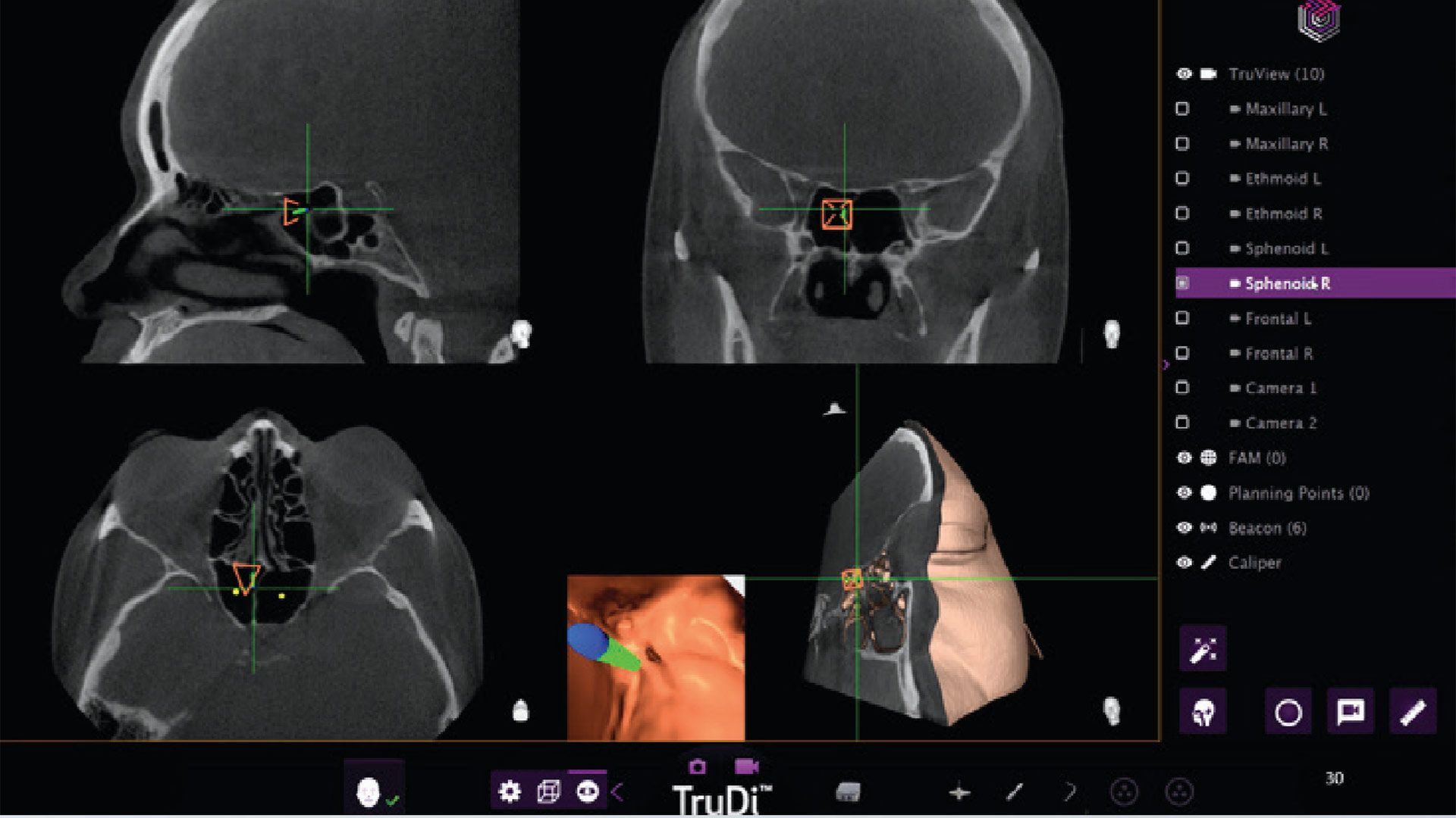 Adding AI to sinus surgery system saw malfunctions rocket from eight to 100 incidents, according to new investigation — skull-puncturing errors are the stuff of